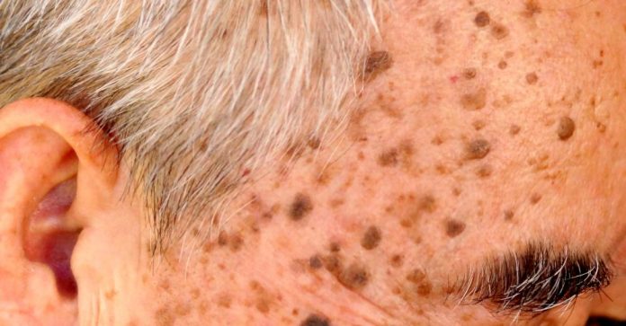 Alterswarzen – meist harmlose Hautveränderungen ohne Behandlungsbedarf  