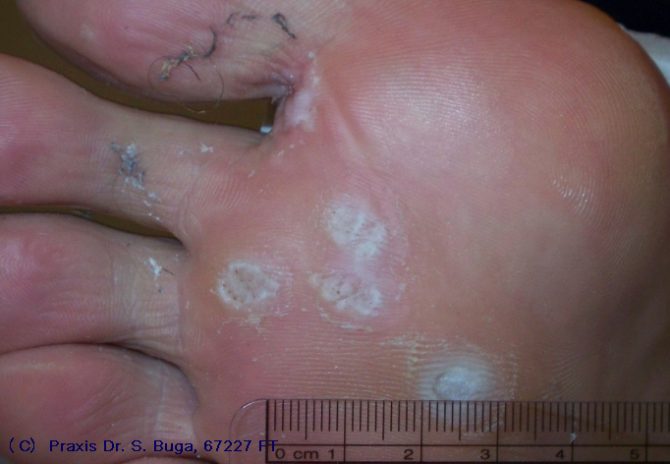 Flachwarzen (Verrucae planae) – harmlose kleine Hautveränderungen