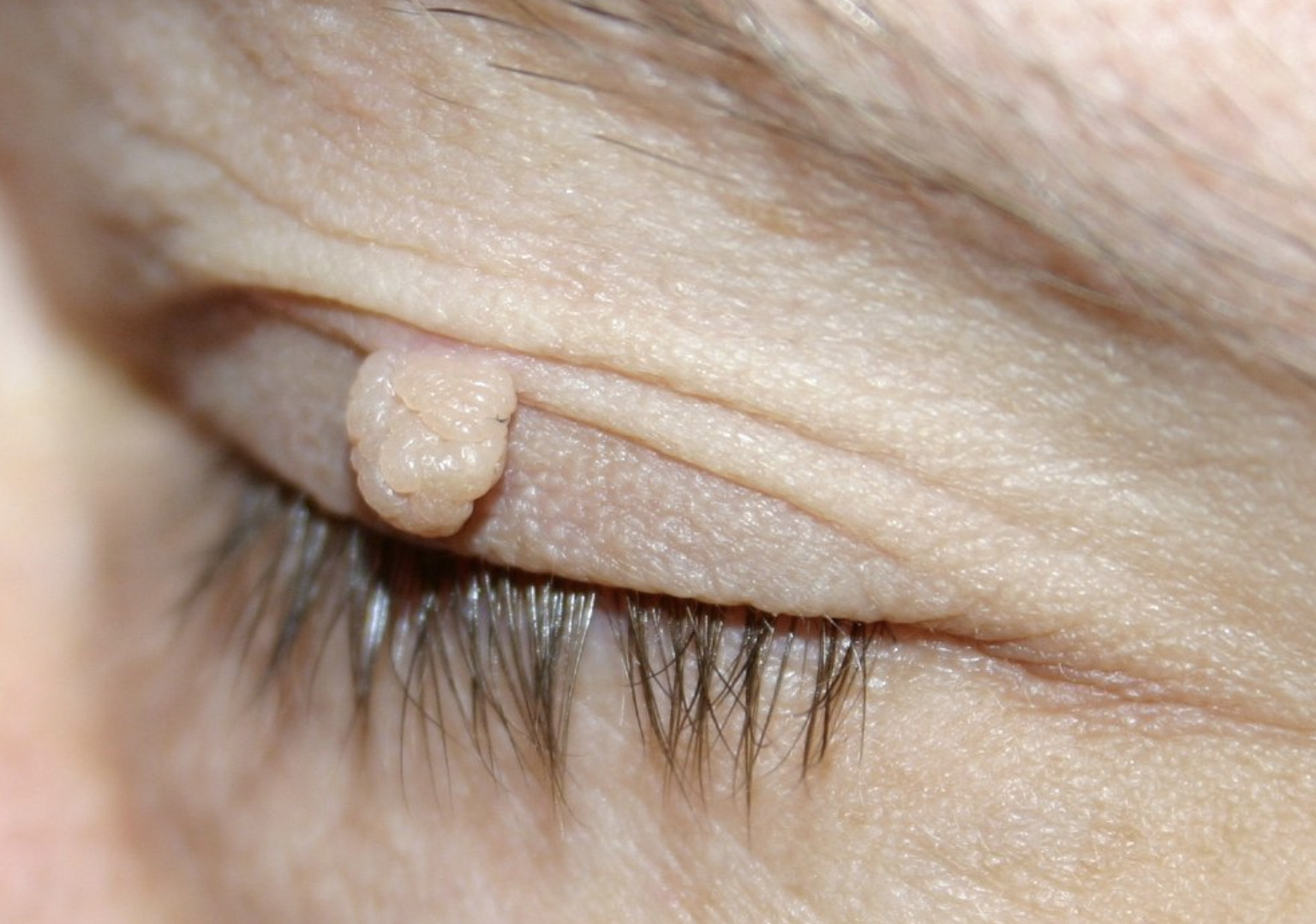 Wie Lange Krank Geschrieben Nach Dornwarzen Op Verlauf – so heilen Warzen wieder ab